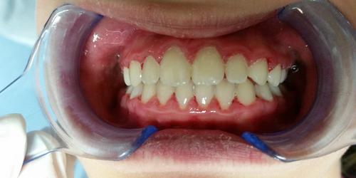 Zähne nach der Behandlung