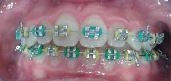 Zahnspange Fixbehandlung